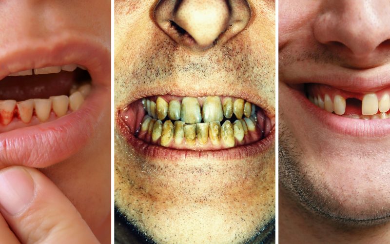 यदि तपाईँ गिजाबाट रगत बग्ने समस्याबाट पीडित हुनुहुन्छ भने, रोकथामका लागि यी सरल उपायहरू पालना गर्नुहोस्