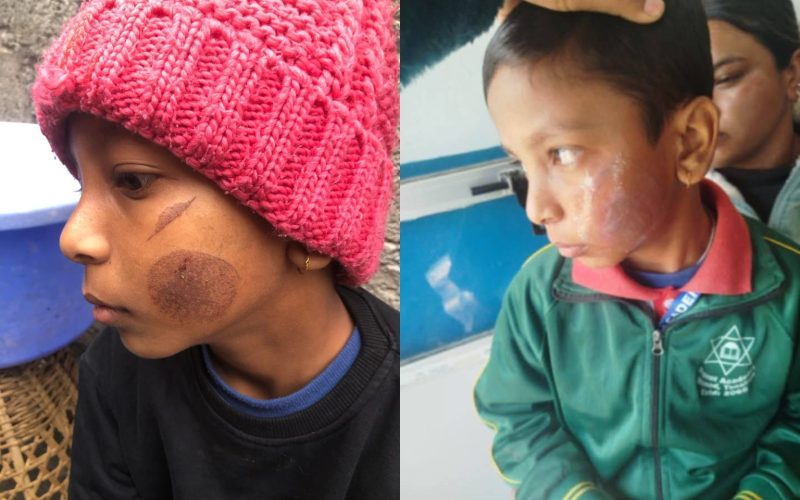 तनहुँमा शिक्षिकाले तातो पन्युँले तीन विद्यार्थीको गाला डामिन्, पक्रियो प्रहरीले